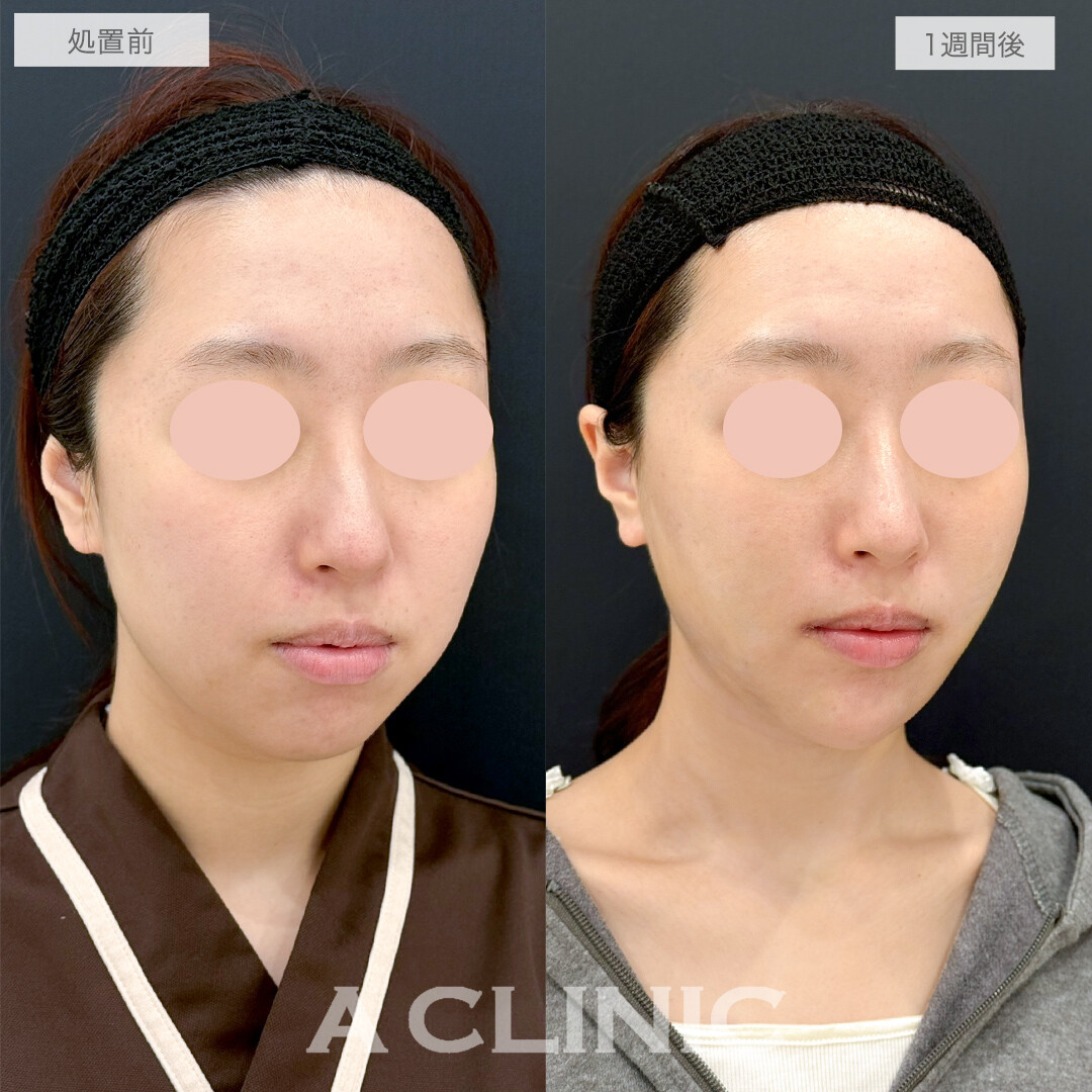 複合施術で笑顔も整い垢抜け感のある小顔になりました！処置前と1週間後の症例です(20代女性)