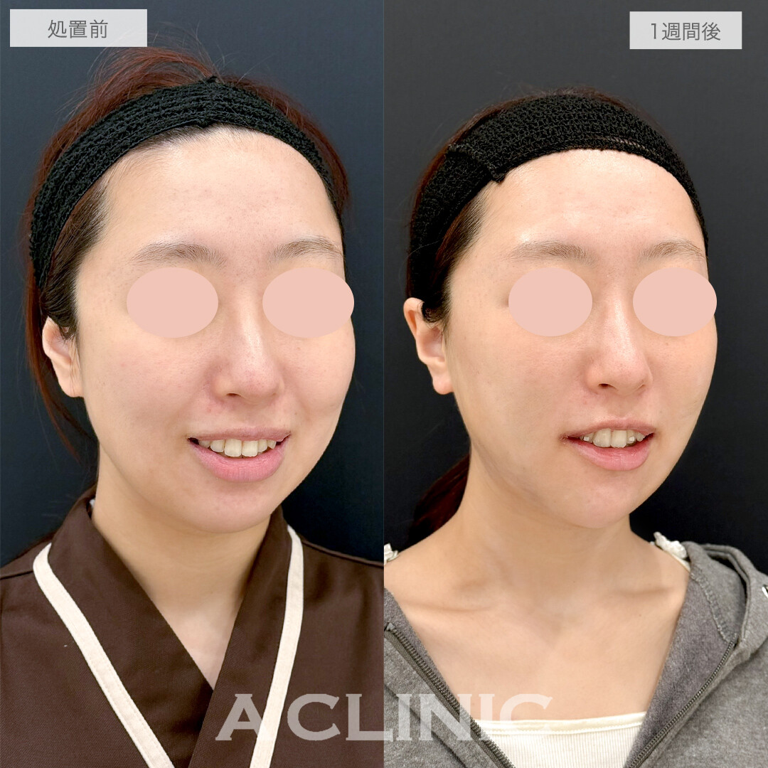 複合施術で笑顔も整い垢抜け感のある小顔になりました！処置前と1週間後の症例です(20代女性)