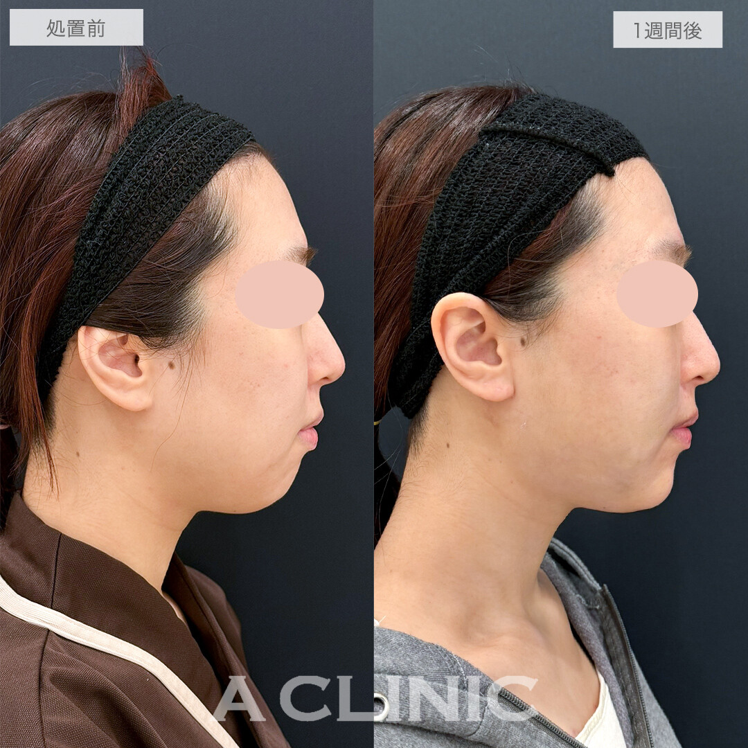 複合施術で笑顔も整い垢抜け感のある小顔になりました！処置前と1週間後の症例です(20代女性)