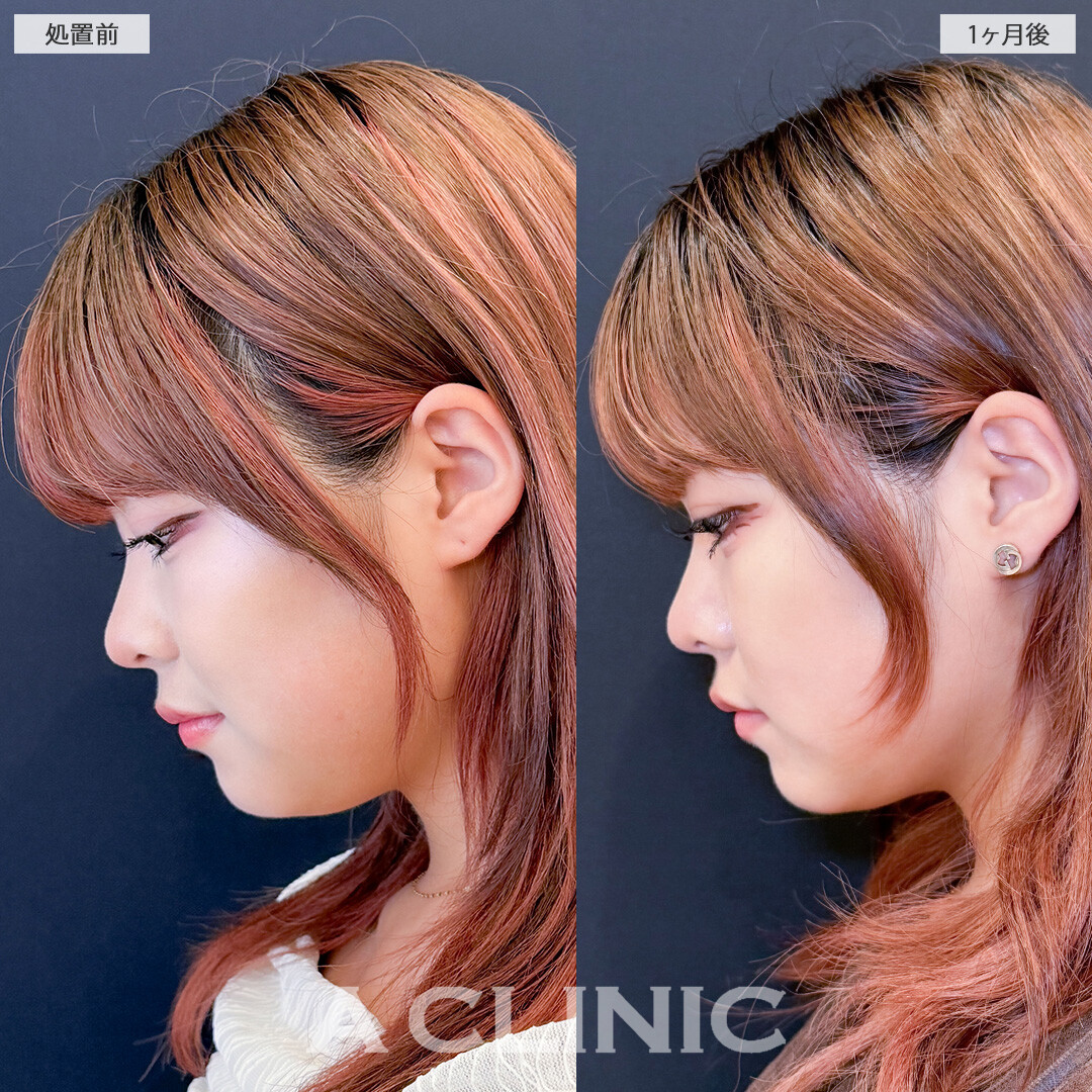 1day小顔脂肪吸引で丸顔っぽさを自然に解消！こちら処置前と1ヶ月後の症例です(20代女性)