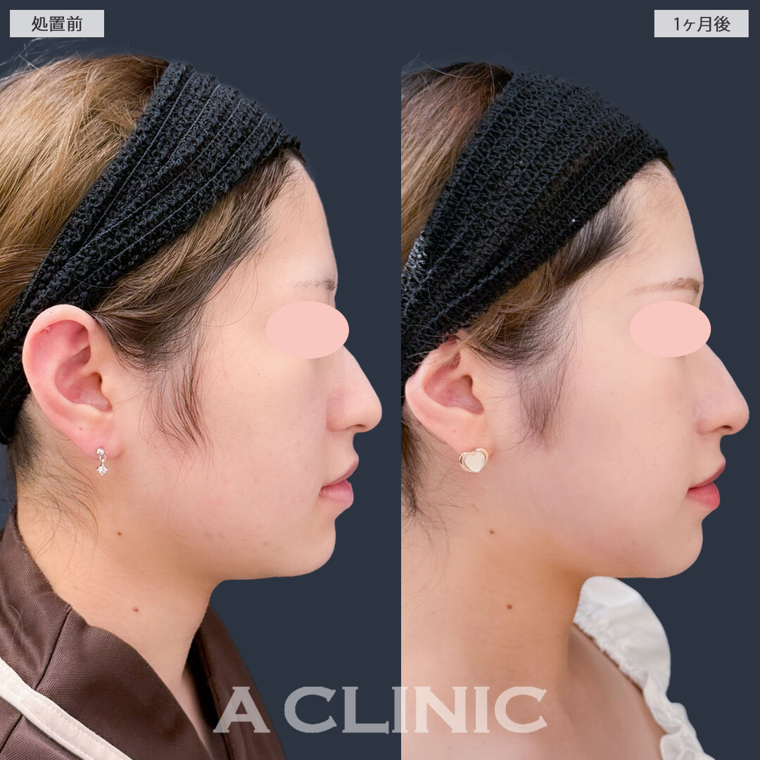 1day小顔脂肪吸引でお顔のボリューム感減らしてスッキリ理想の小顔に！こちら処置前と1ヶ月後の症例です(20代女性)