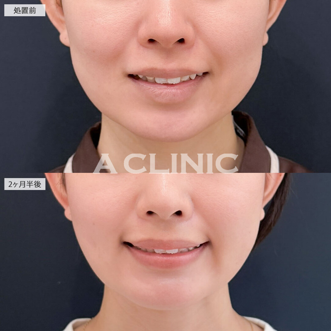 1day小顔脂肪吸引で周囲にバレずにこっそり垢抜け！こちら処置前と2ヶ月半後の症例です(20代女性)