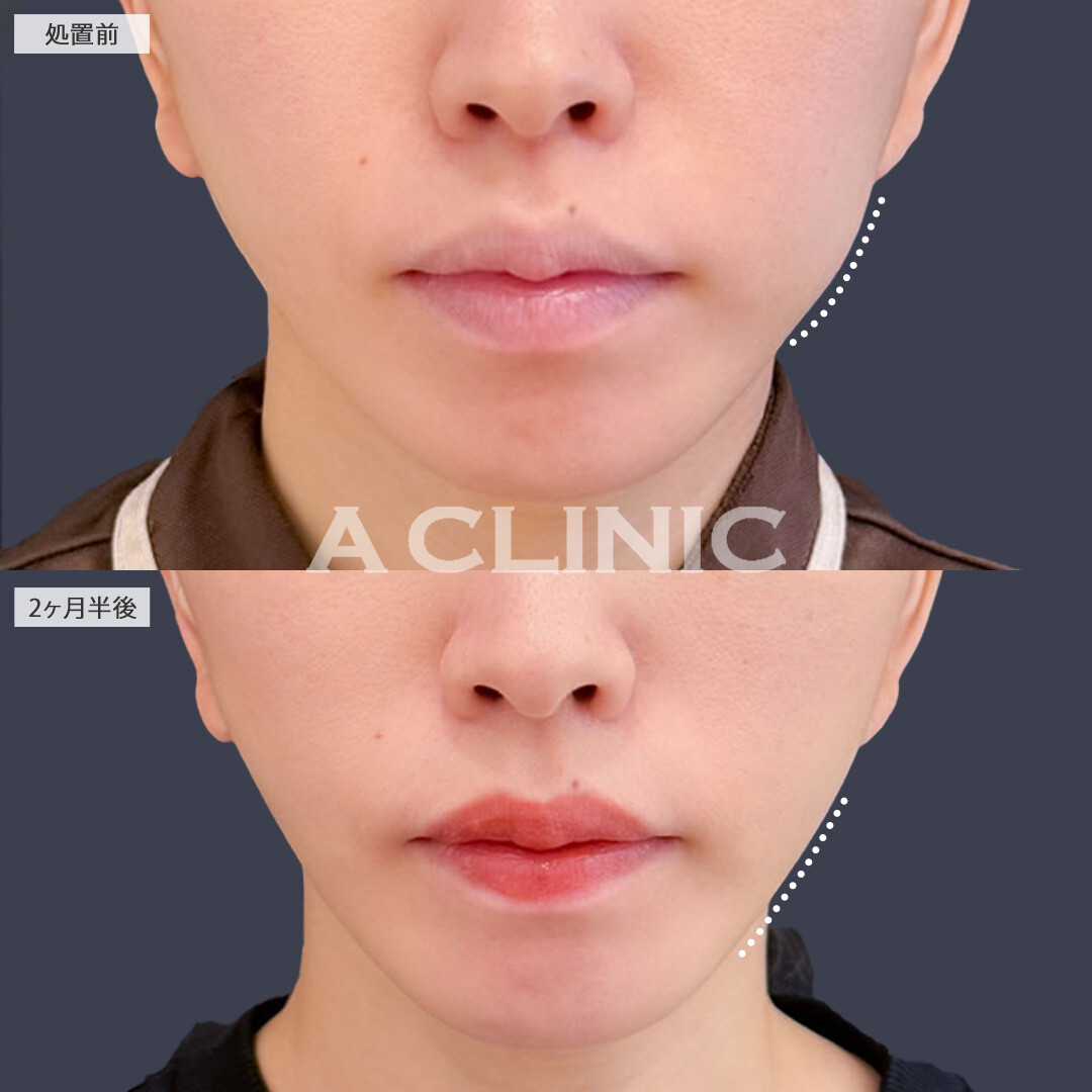 1day小顔脂肪吸引で余分な脂肪なくしてしっかり小顔に！こちら処置前と2ヶ月半後の症例です(30代女性)