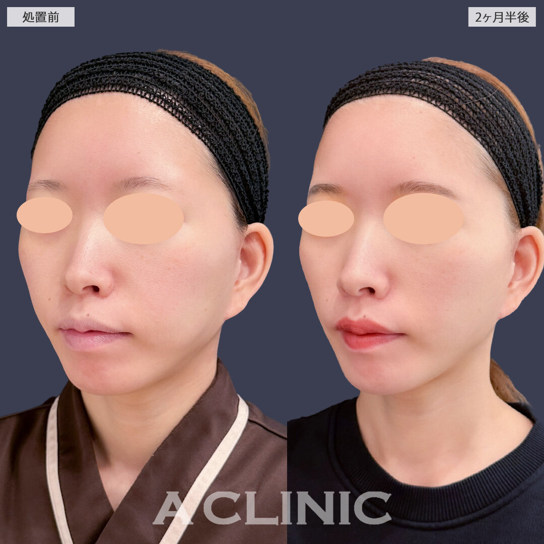 1day小顔脂肪吸引で余分な脂肪なくしてしっかり小顔に！こちら処置前と2ヶ月半後の症例です(30代女性)