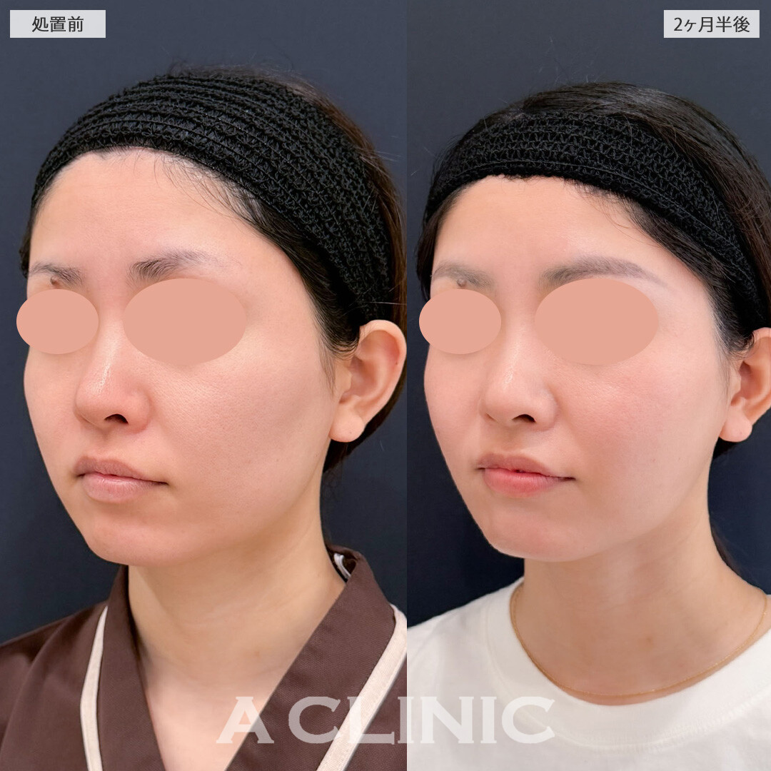 1day小顔脂肪吸引で周囲にバレずにこっそり垢抜け！こちら処置前と2ヶ月半後の症例です(20代女性)
