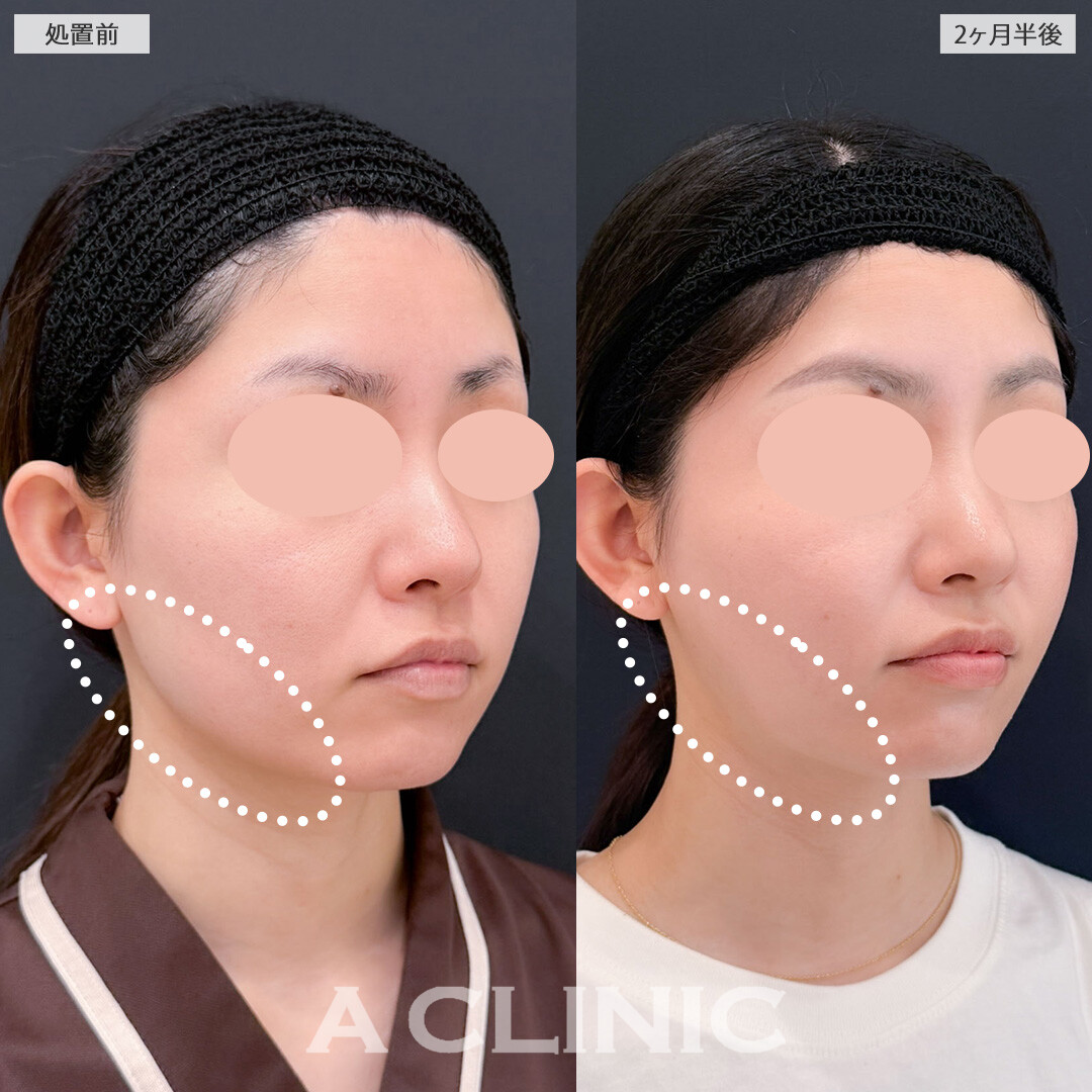 1day小顔脂肪吸引で周囲にバレずにこっそり垢抜け！こちら処置前と2ヶ月半後の症例です(20代女性)