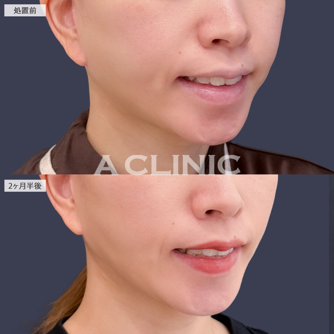 1day小顔脂肪吸引で余分な脂肪なくしてしっかり小顔に！こちら処置前と2ヶ月半後の症例です(30代女性)