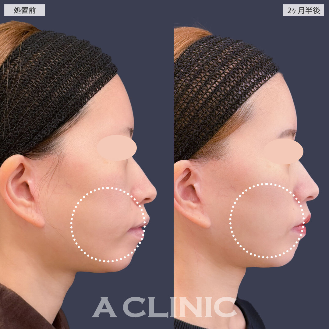 1day小顔脂肪吸引で余分な脂肪なくしてしっかり小顔に！こちら処置前と2ヶ月半後の症例です(30代女性)