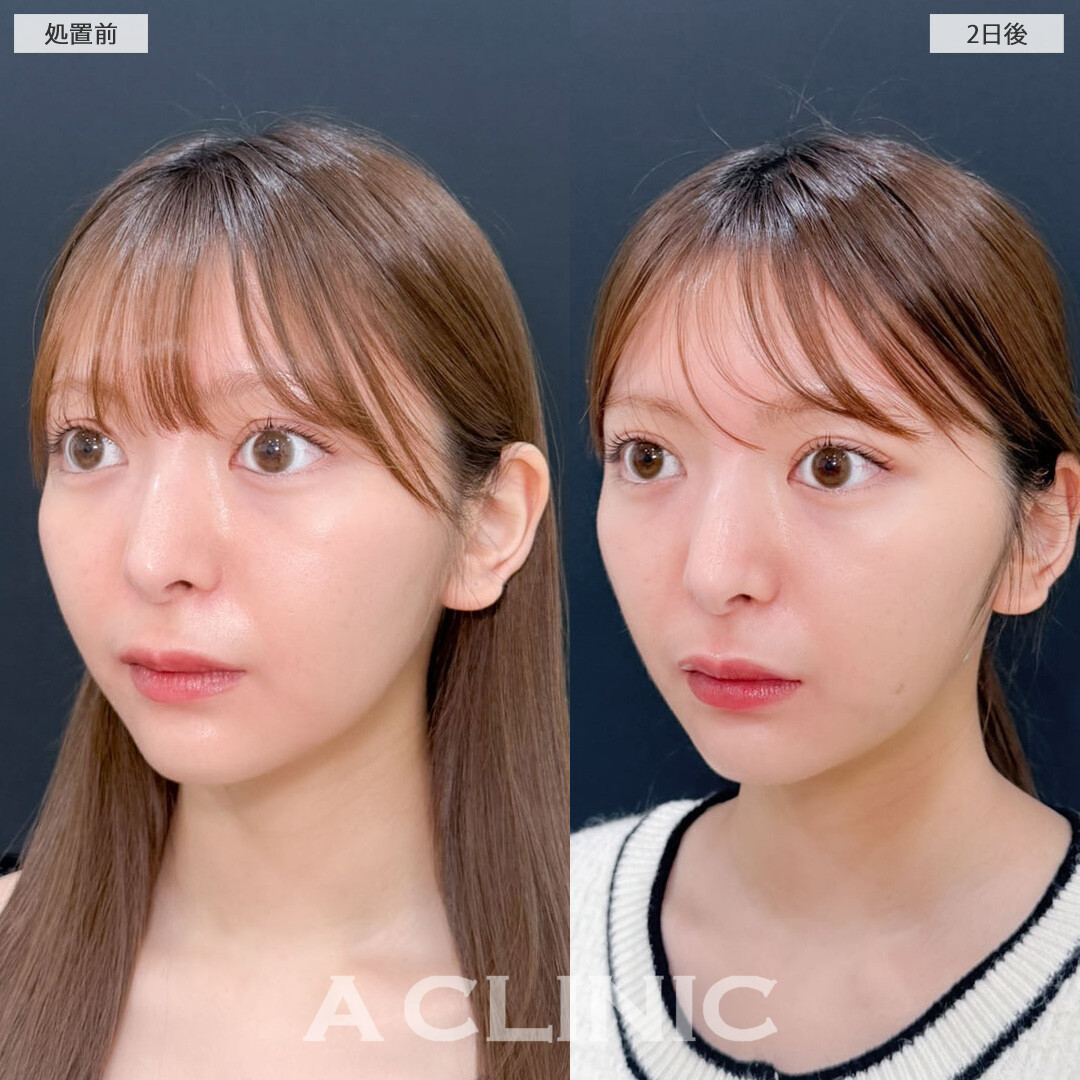 1day小顔脂肪吸引で小顔をさらに可愛くアップデート！こちら処置前と2日後の症例です(20代女性)