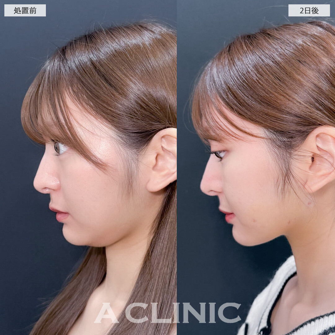 1day小顔脂肪吸引で小顔をさらに可愛くアップデート！こちら処置前と2日後の症例です(20代女性)