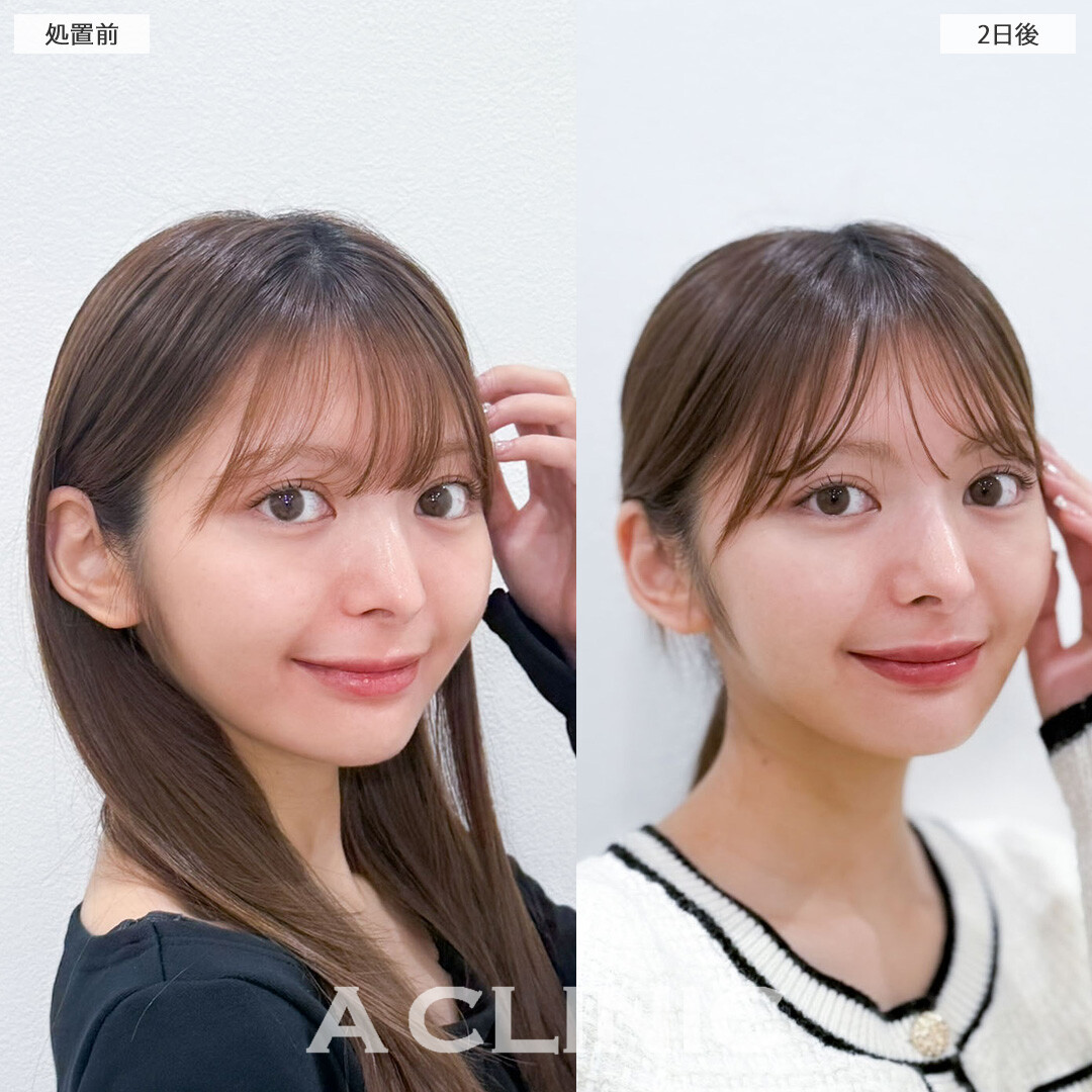 1day小顔脂肪吸引で小顔をさらに可愛くアップデート！こちら処置前と2日後の症例です(20代女性)
