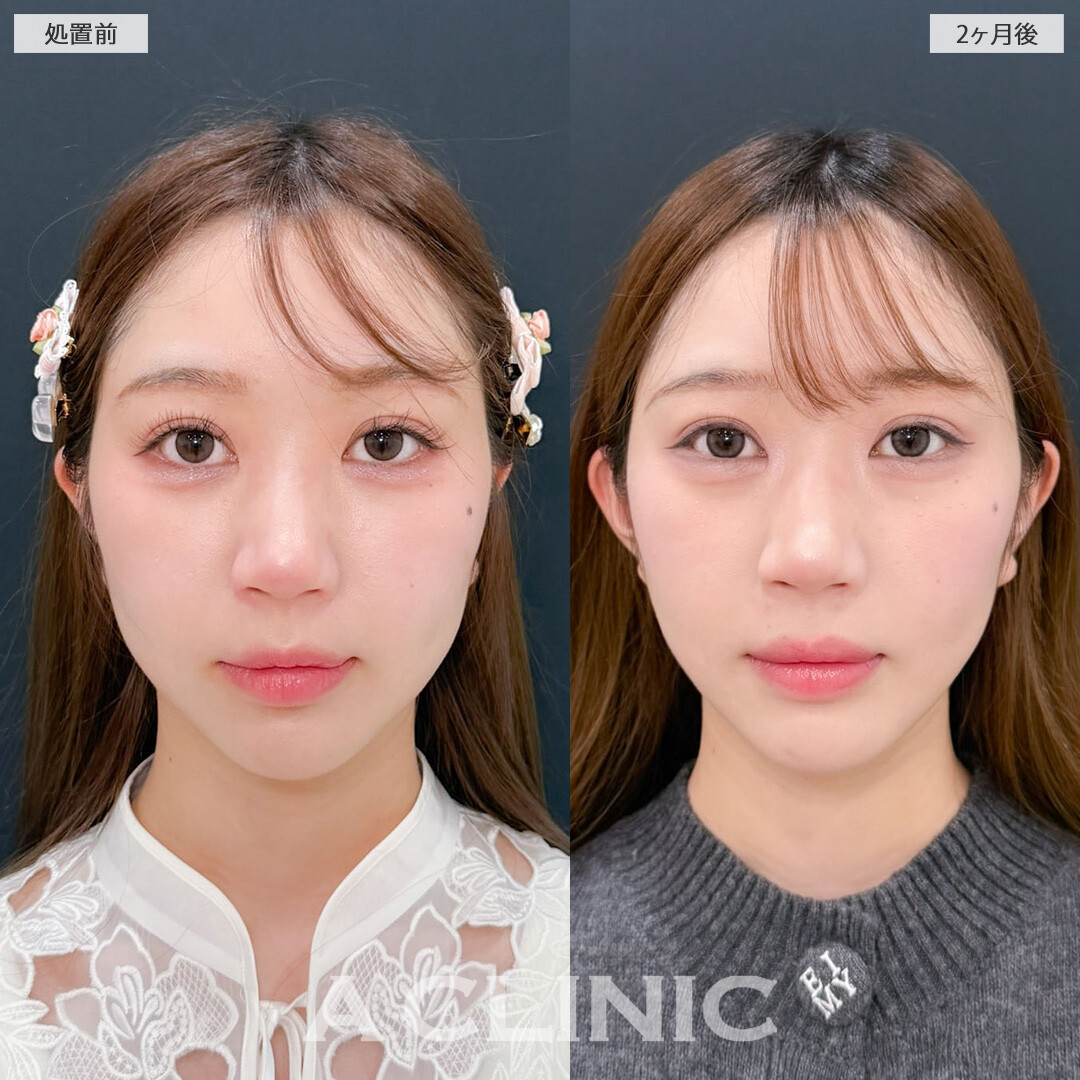 1day小顔脂肪吸引と立ち耳ヒアルロン酸注入(ボリューマ)でナチュラルに垢抜け大成功！こちら処置前と2ヶ月後の症例です(20代女性)