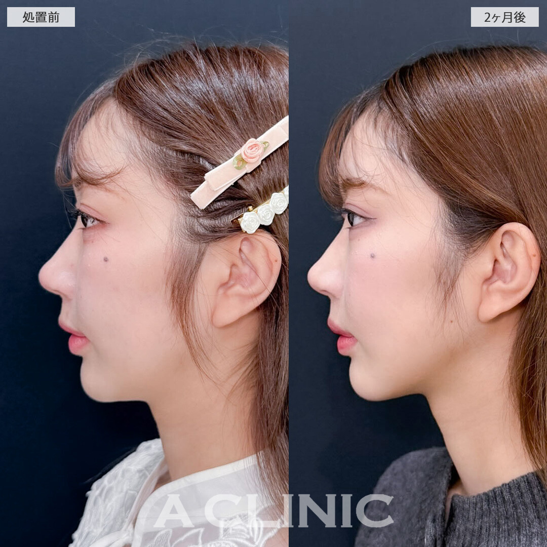 1day小顔脂肪吸引と立ち耳ヒアルロン酸注入(ボリューマ)でナチュラルに垢抜け大成功！こちら処置前と2ヶ月後の症例です(20代女性)