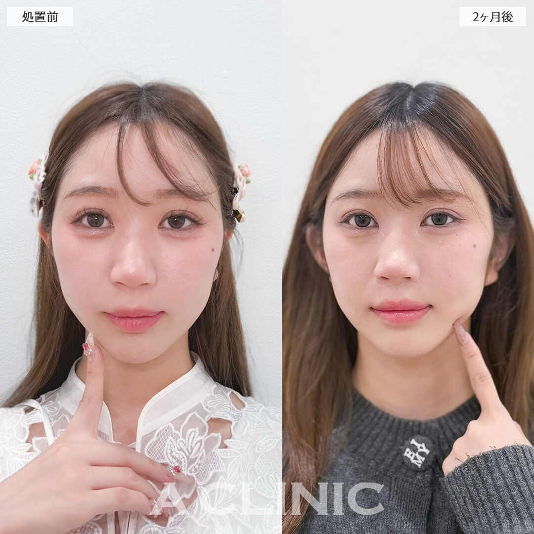 1day小顔脂肪吸引と立ち耳ヒアルロン酸注入(ボリューマ)でナチュラルに垢抜け大成功！こちら処置前と2ヶ月後の症例です(20代女性)
