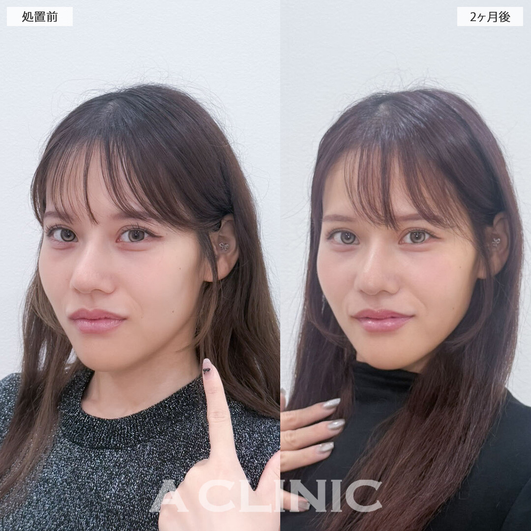 1day小顔脂肪吸引でナチュラルな小顔になれました!こちら処置前と2ヵ月後の症例です(20代女性)