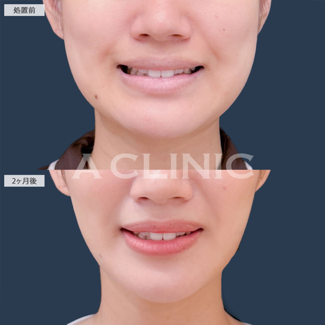 1day小顔脂肪吸引とバッカルファット除去術でどんな瞬間も小顔に！こちら処置前と2ヵ月後の症例です(20代女性)