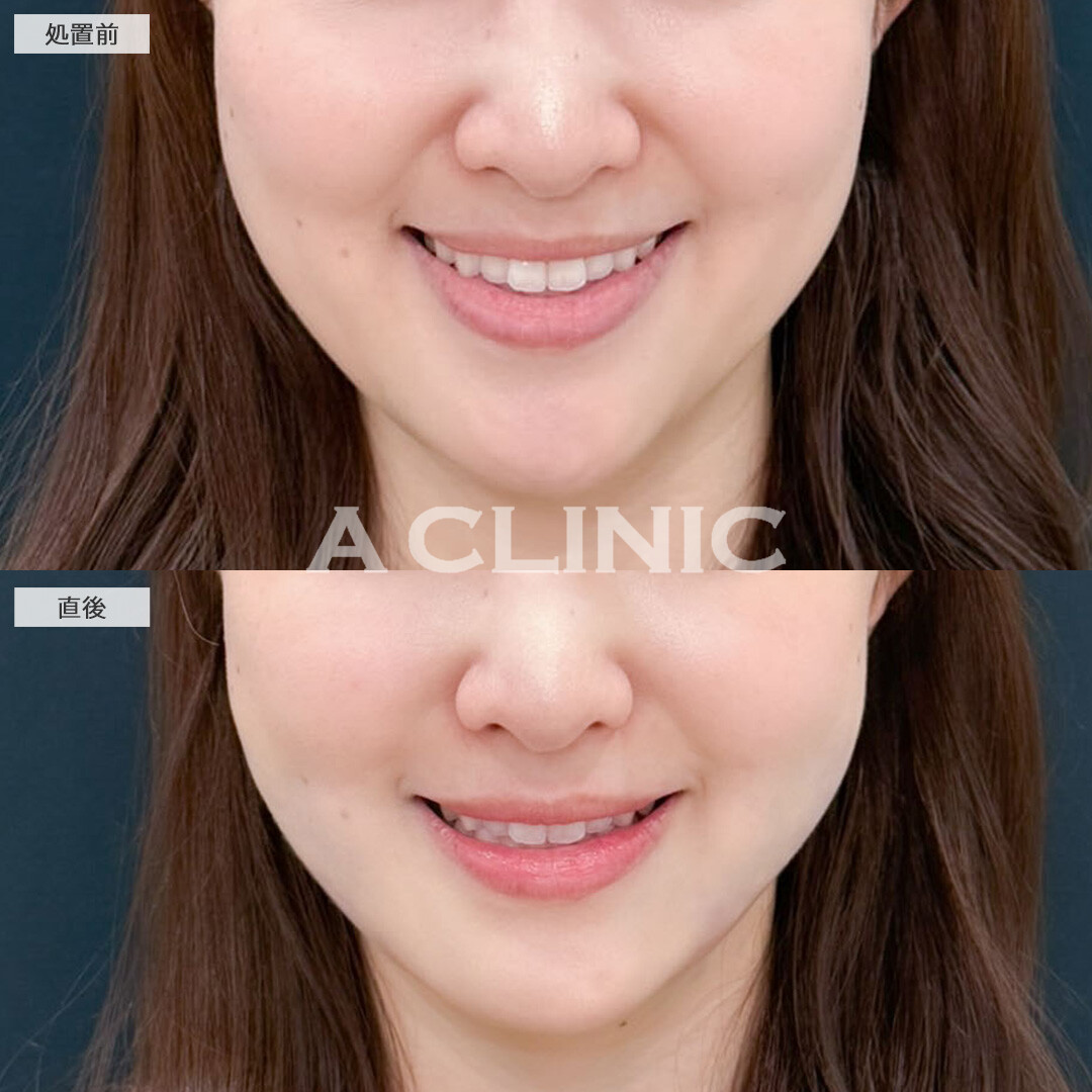 1day小顔脂肪吸引は即日小顔が叶います！こちら処置前と直後の症例です(30代女性)