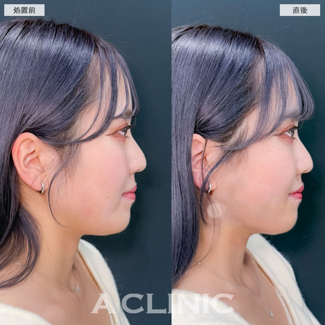 1day小顔脂肪吸引で自然な丸みは残しつつ全体的なボリュームおさえてアゴ下ペラペラに！こちら処置前と直後の症例です(20代女性)