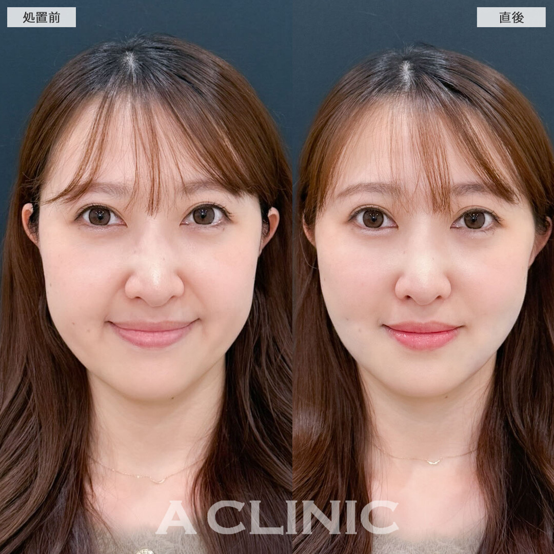 1day小顔脂肪吸引は即日小顔が叶います！こちら処置前と直後の症例です(30代女性)