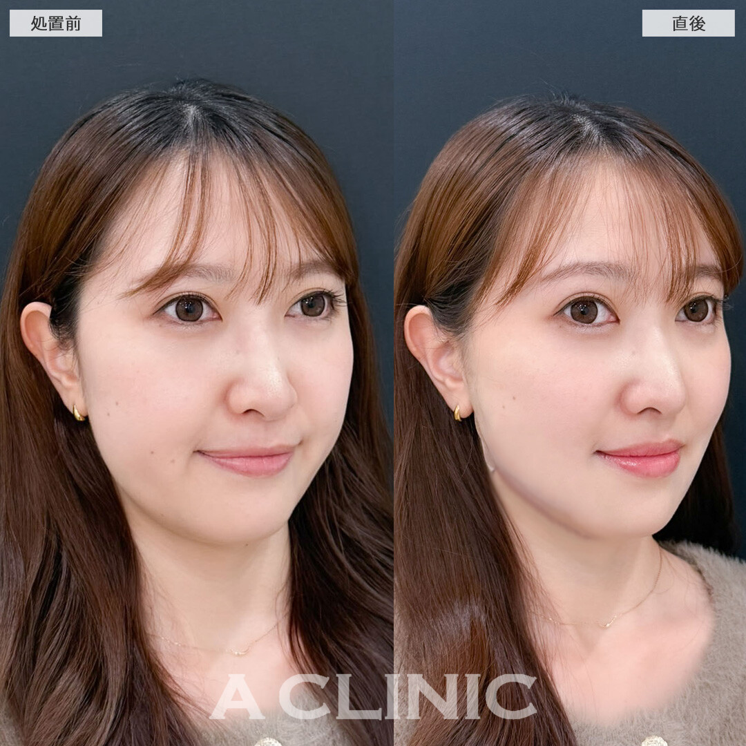 1day小顔脂肪吸引は即日小顔が叶います！こちら処置前と直後の症例です(30代女性)