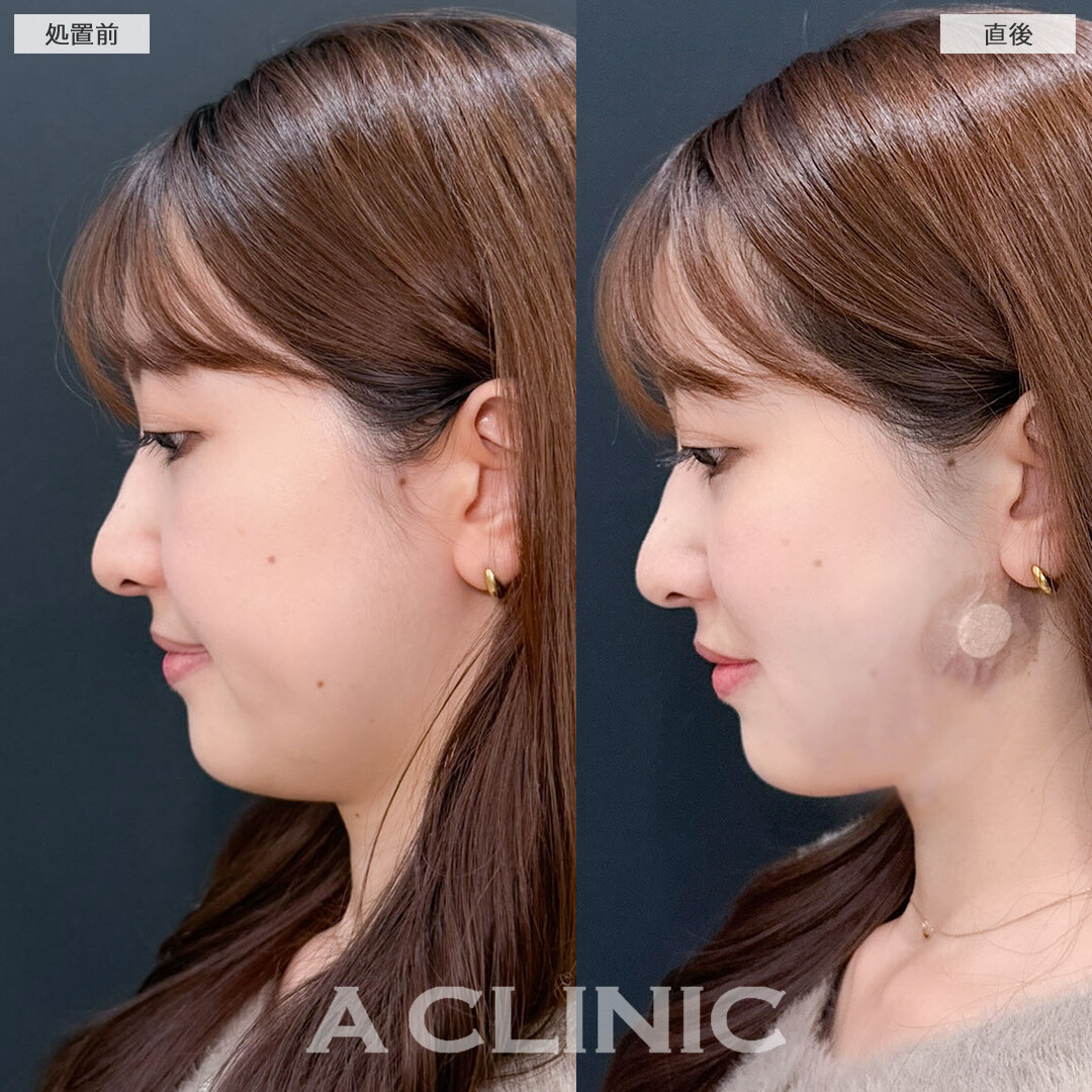 1day小顔脂肪吸引は即日小顔が叶います！こちら処置前と直後の症例です(30代女性)