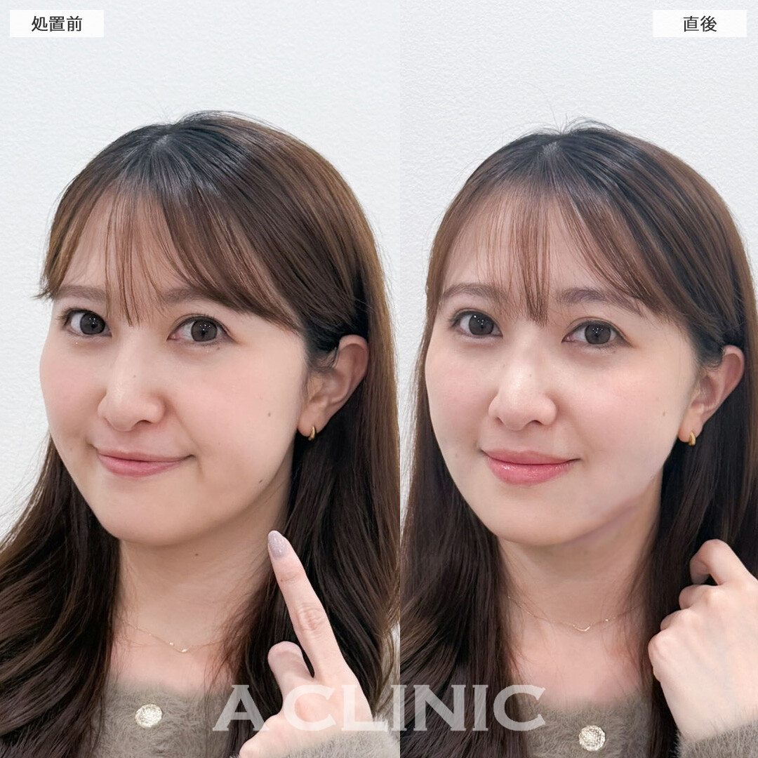 1day小顔脂肪吸引は即日小顔が叶います！こちら処置前と直後の症例です(30代女性)