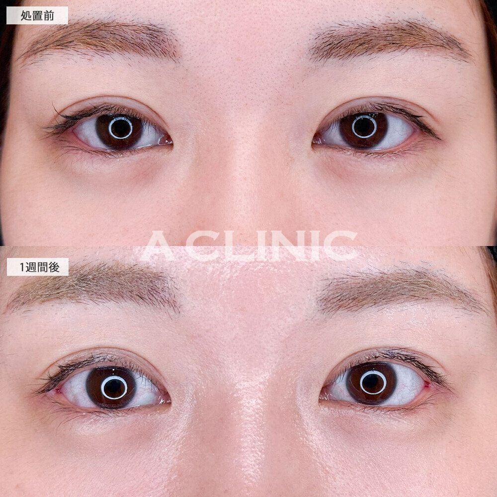 パーフェクトアイズで自然なタレ目に！こちら処置前と1週間後の症例です(20代女性)