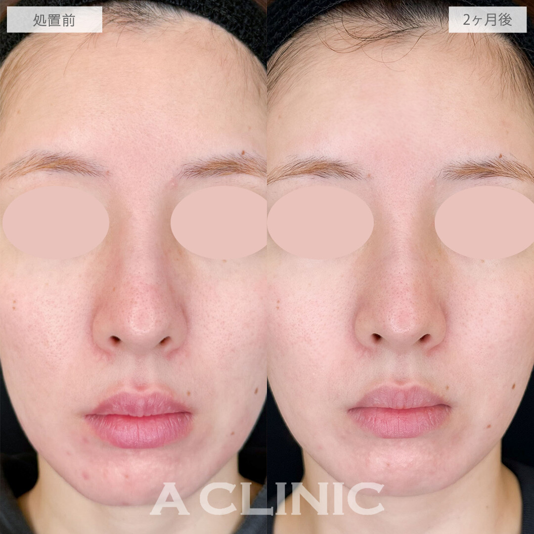 ポテンツァとケミカルピーリングでニキビ跡が改善しました！こちら処置前と2ヶ月後の症例です(30代女性)