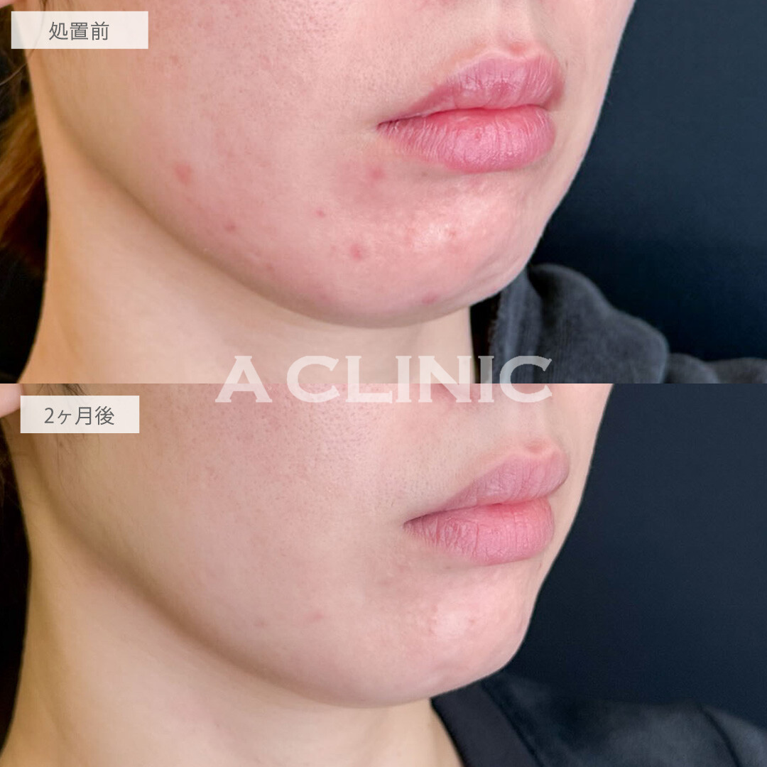 ポテンツァとケミカルピーリングでニキビ跡が改善しました！こちら処置前と2ヶ月後の症例です(30代女性)