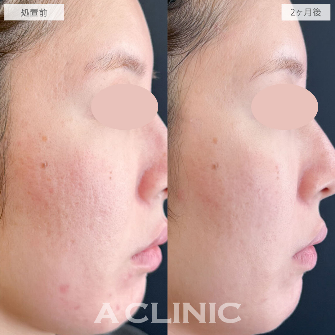 ポテンツァとケミカルピーリングでニキビ跡が改善しました！こちら処置前と2ヶ月後の症例です(30代女性)