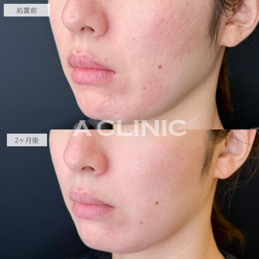 ポテンツァとケミカルピーリングでニキビ跡が改善しました！こちら処置前と2ヶ月後の症例です(30代女性)