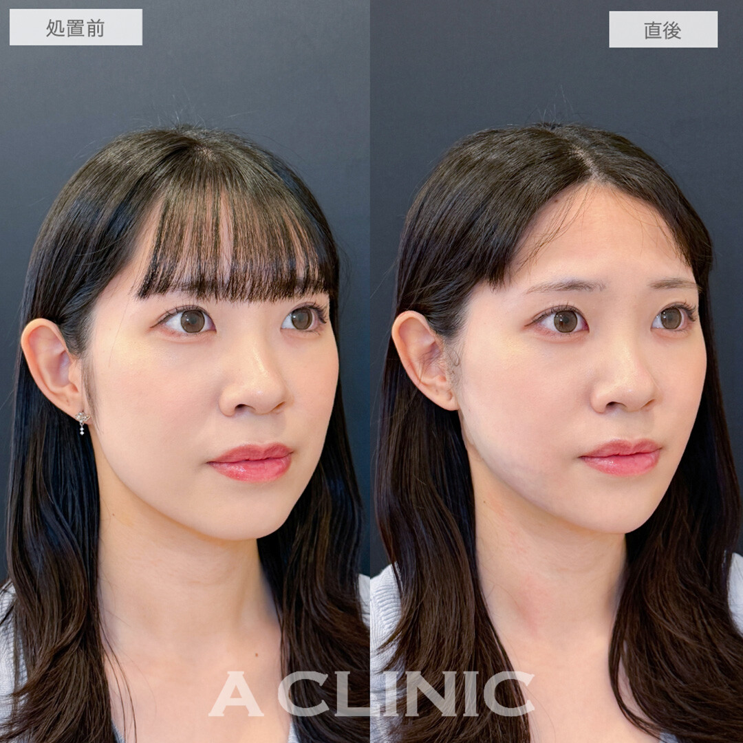 1day小顔脂肪吸引とあごへのヒアルロン酸注入で直後から垢抜け大成功！処置前と直後の症例です(20代女性)