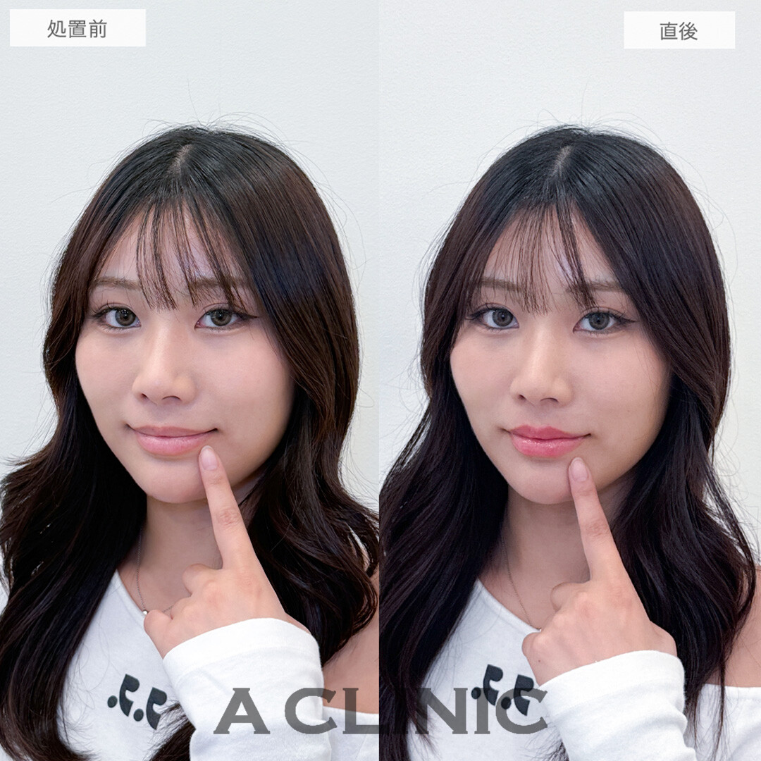 スマイルリップでバランスよくボリュームのある唇に！処置前と直後の症例です(20代女性)