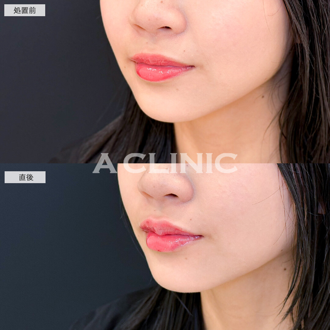 スマイルリップで唇のボリュームUPして人中も短く見えるようになりました！こちら処置前と直後の症例です(20代女性)