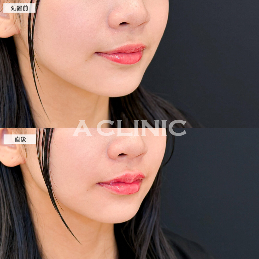 スマイルリップで唇のボリュームUPして人中も短く見えるようになりました！こちら処置前と直後の症例です(20代女性)
