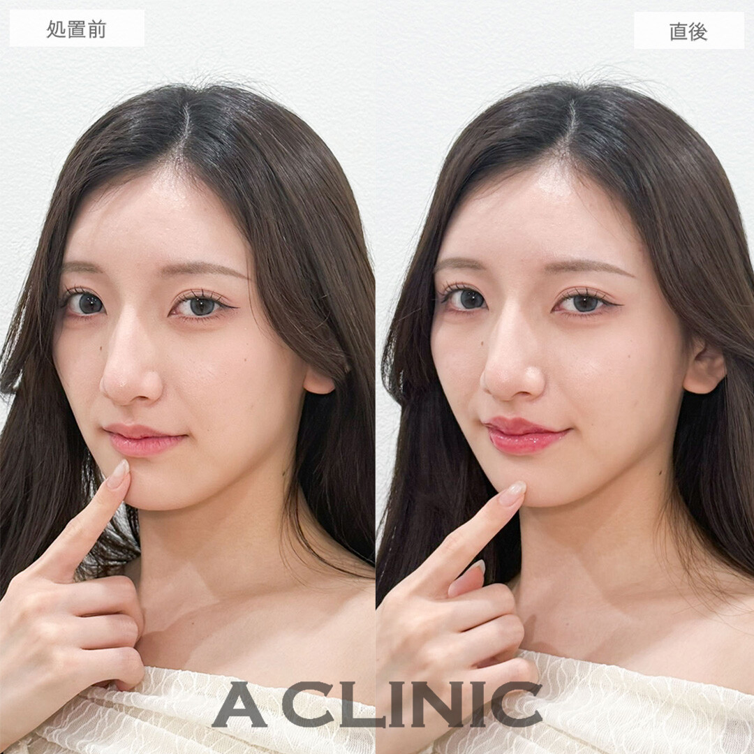スマイルリップでぷっくり可愛い唇に！こちら処置前と直後の症例です(20代女性)