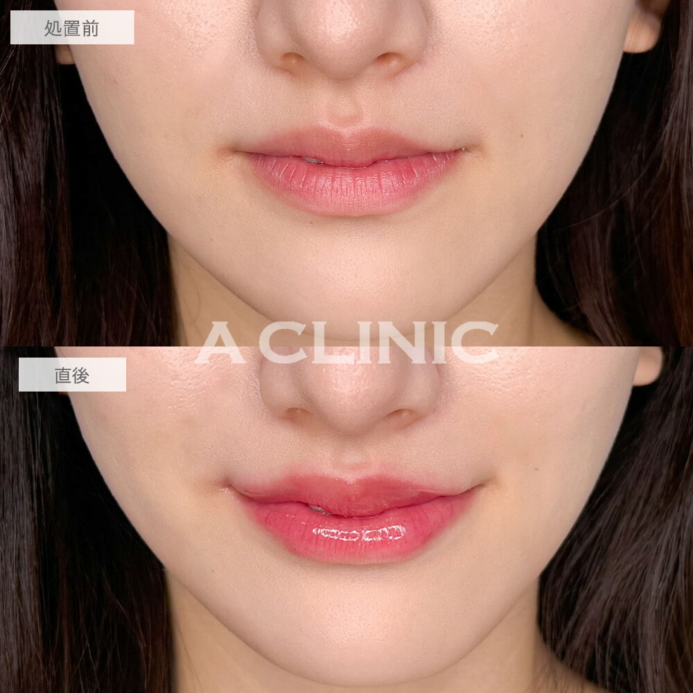 スマイルリップでぷっくり可愛い唇に！こちら処置前と直後の症例です(20代女性)