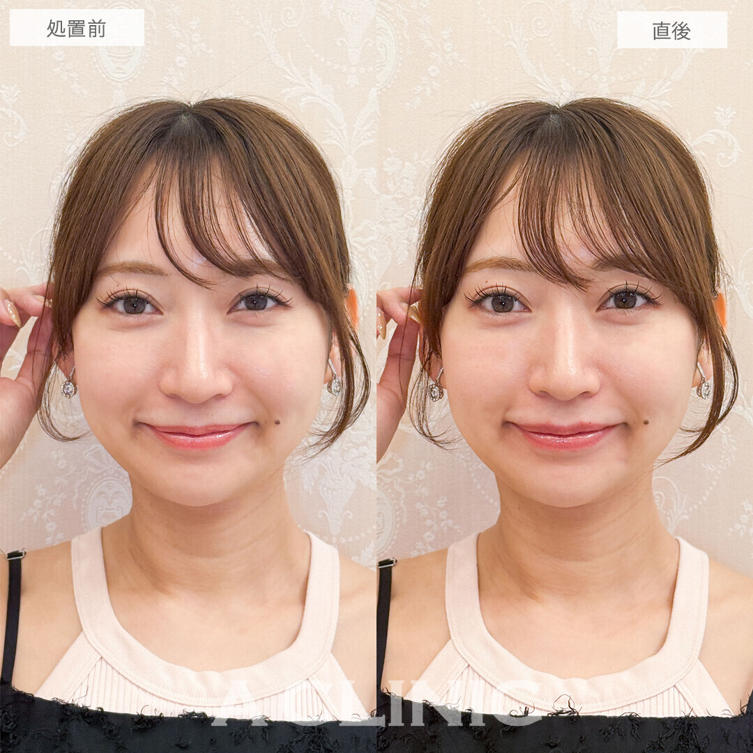 スマイルリップでぷっくり可愛い唇になりました！処置前と直後の症例です(20代女性)