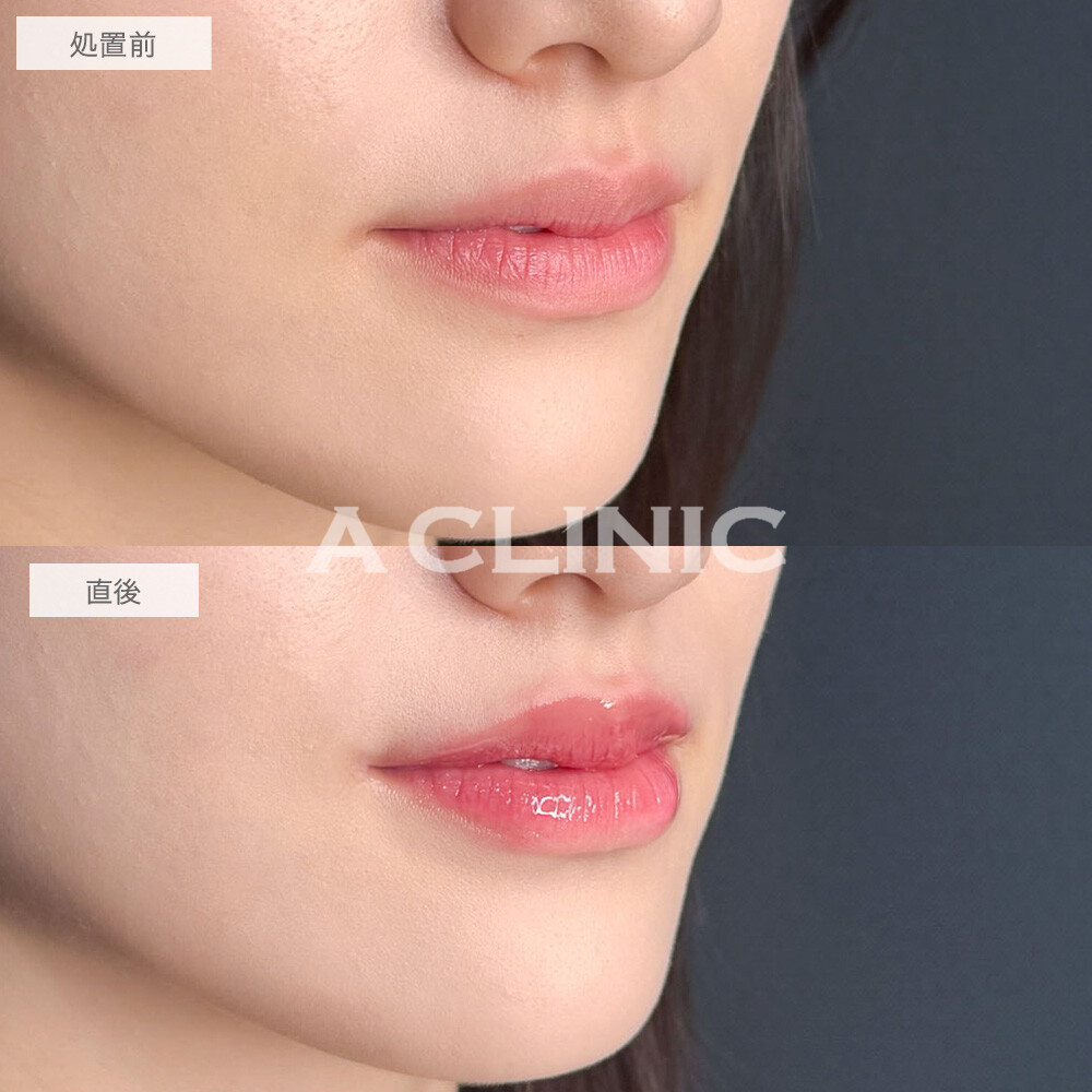 スマイルリップでぷっくり可愛い唇に！こちら処置前と直後の症例です(20代女性)