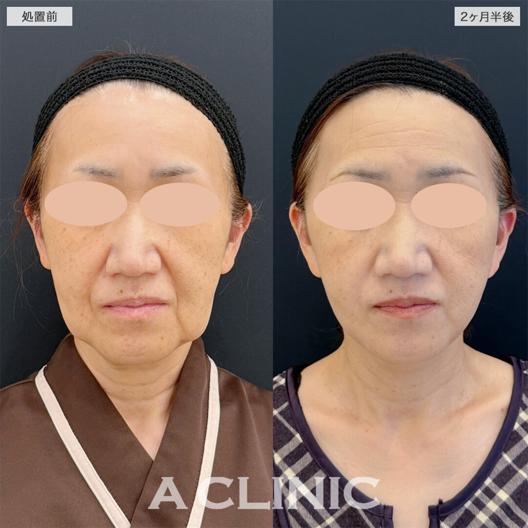 A式美肌たるみ切開で綺麗な卵型フェイスに!こちら処置前と2ヶ月半後の症例です(50代女性)