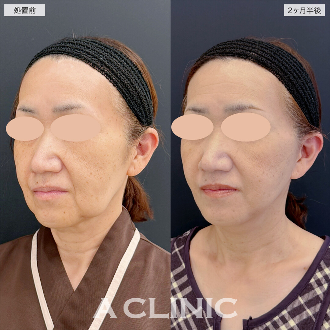 A式美肌たるみ切開で綺麗な卵型フェイスに!こちら処置前と2ヶ月半後の症例です(50代女性)