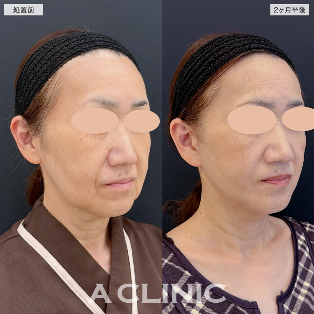 A式美肌たるみ切開で綺麗な卵型フェイスに!こちら処置前と2ヶ月半後の症例です(50代女性)