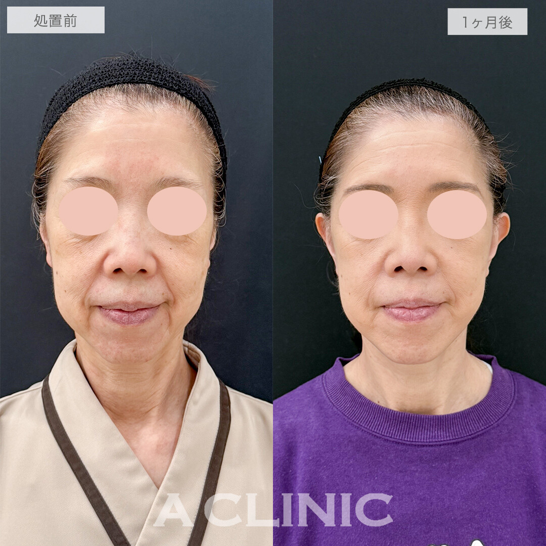 A式美肌たるみ切開なら自然な若返りが叶います！処置前と1ヶ月後の症例です(60代女性)