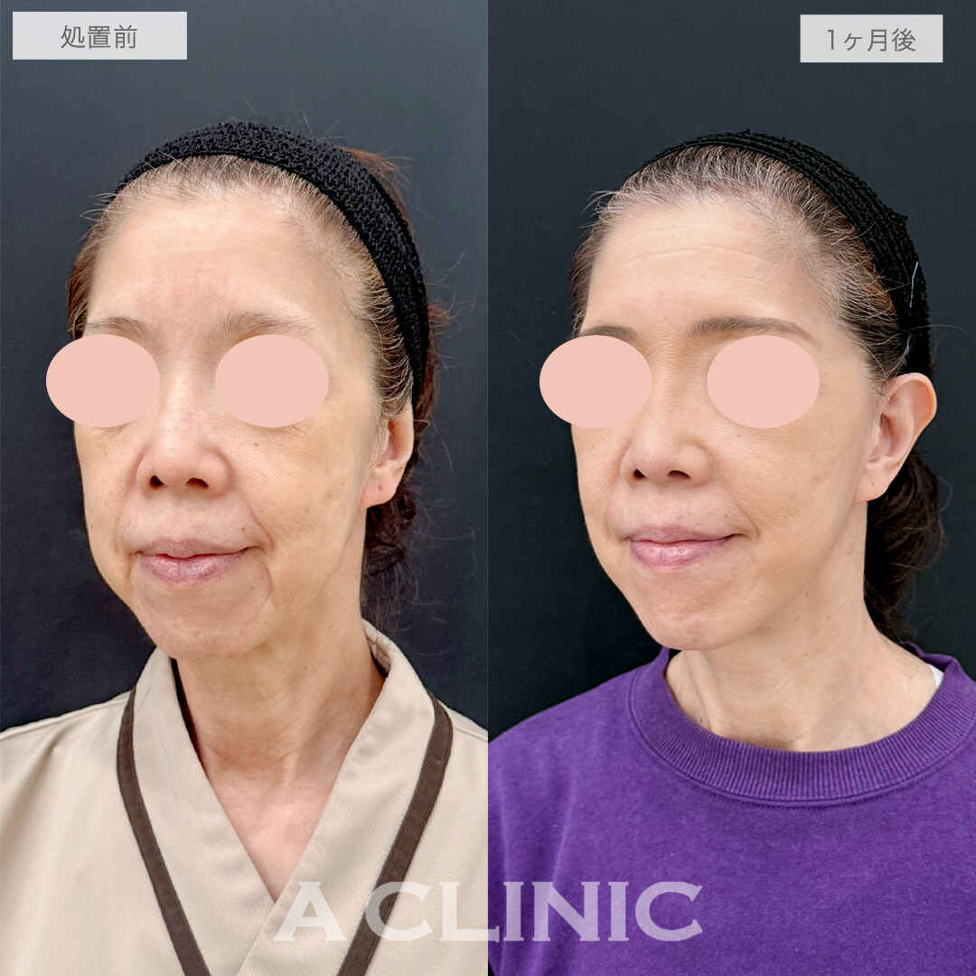 A式美肌たるみ切開なら自然な若返りが叶います！処置前と1ヶ月後の症例です(60代女性)