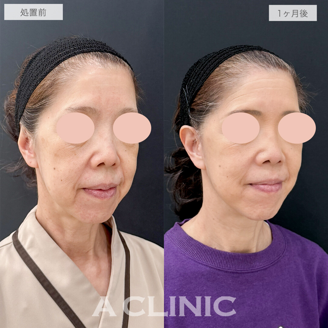A式美肌たるみ切開なら自然な若返りが叶います！処置前と1ヶ月後の症例です(60代女性)