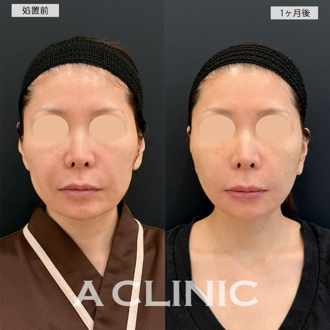 A式美肌たるみ切開でほうれい線のシワが緩和され若返り!こちら処置前と1ヶ月後の症例です(40代女性)