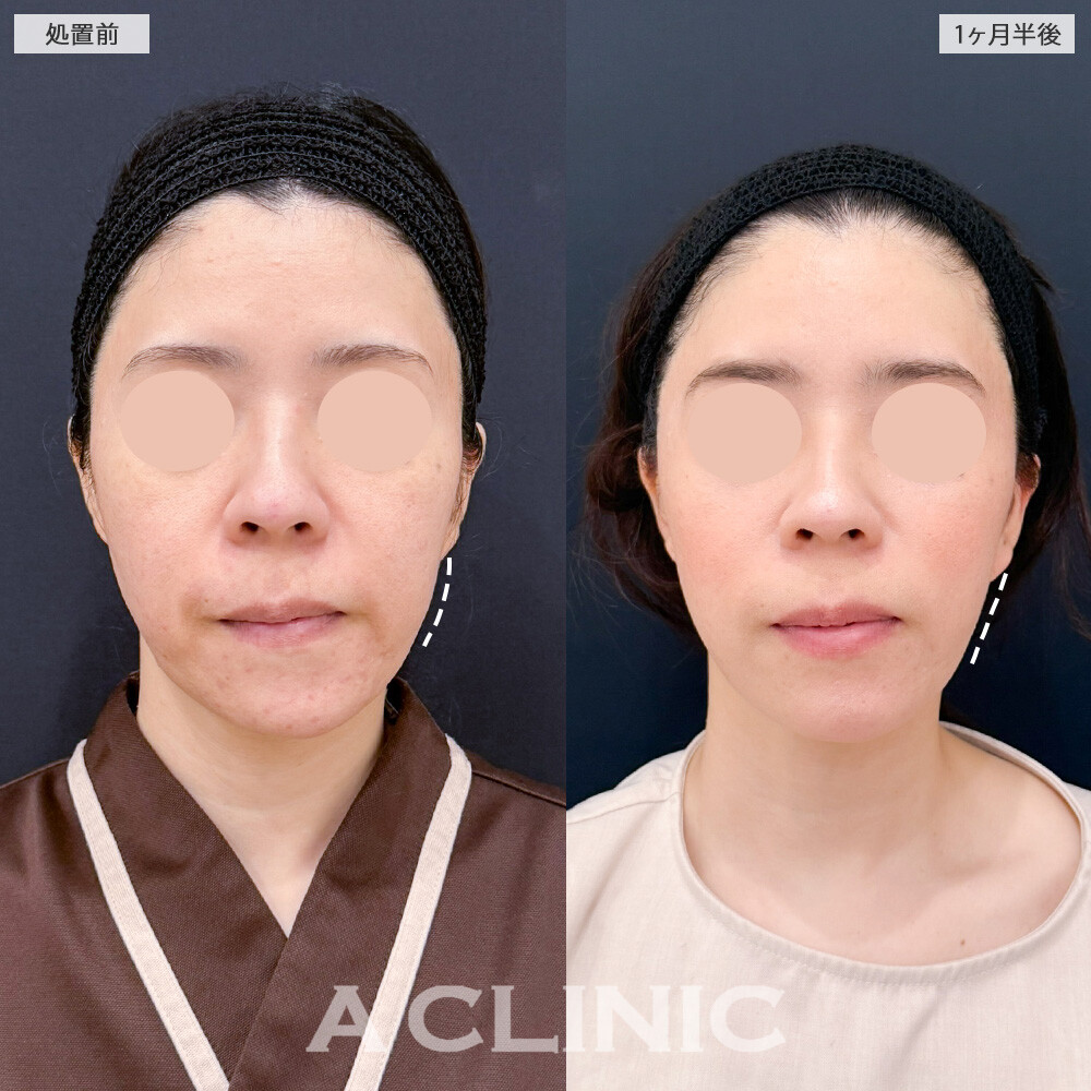 A式美肌たるみ切開と1day小顔脂肪吸引で、たるみとしわを同時に撃退！こちら処置前と１ヶ月半後の症例です(30代女性)