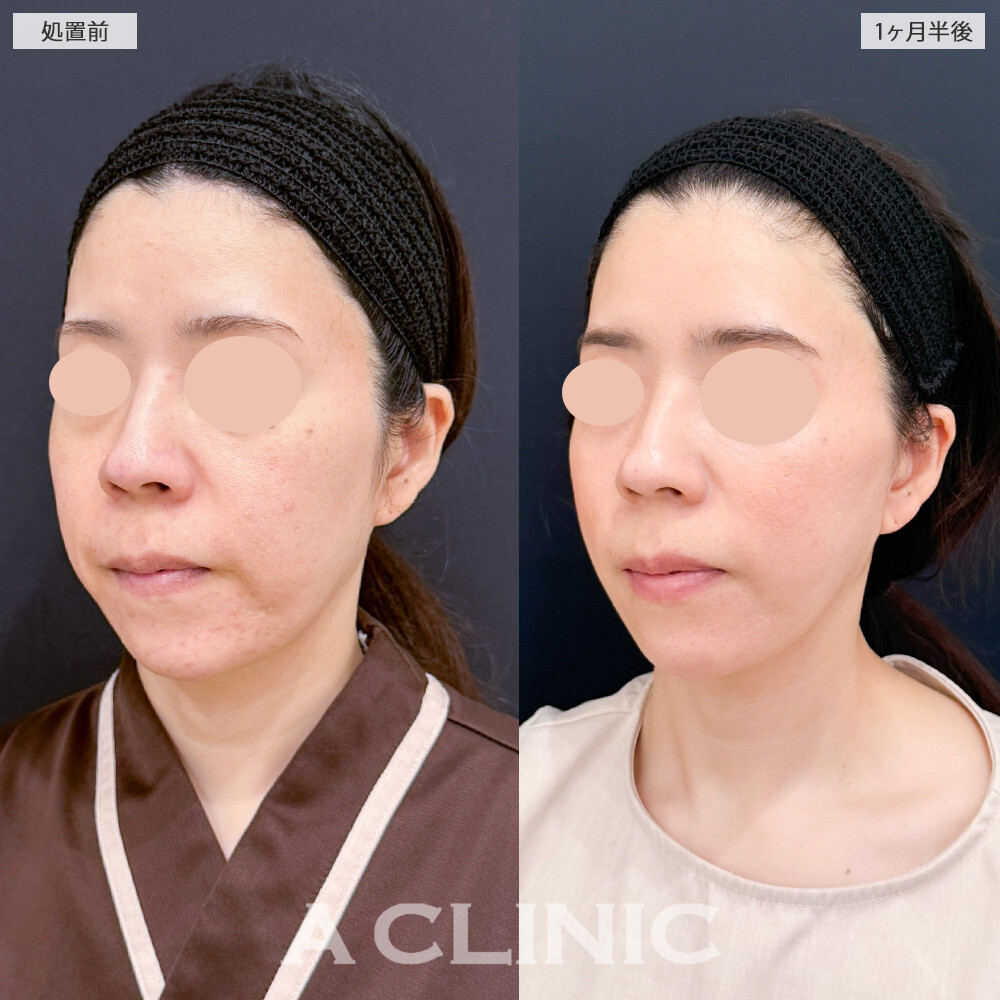 A式美肌たるみ切開と1day小顔脂肪吸引で、たるみとしわを同時に撃退！こちら処置前と１ヶ月半後の症例です(30代女性)