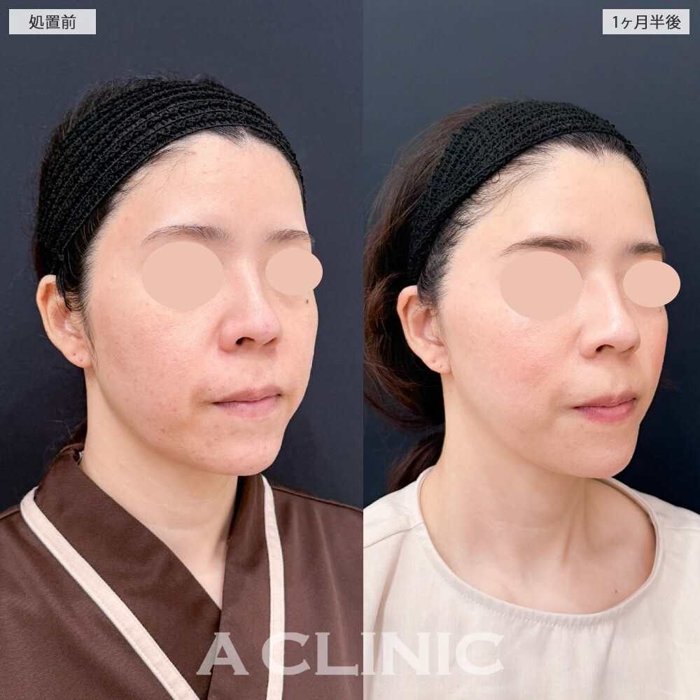 A式美肌たるみ切開と1day小顔脂肪吸引で、たるみとしわを同時に撃退！こちら処置前と１ヶ月半後の症例です(30代女性)