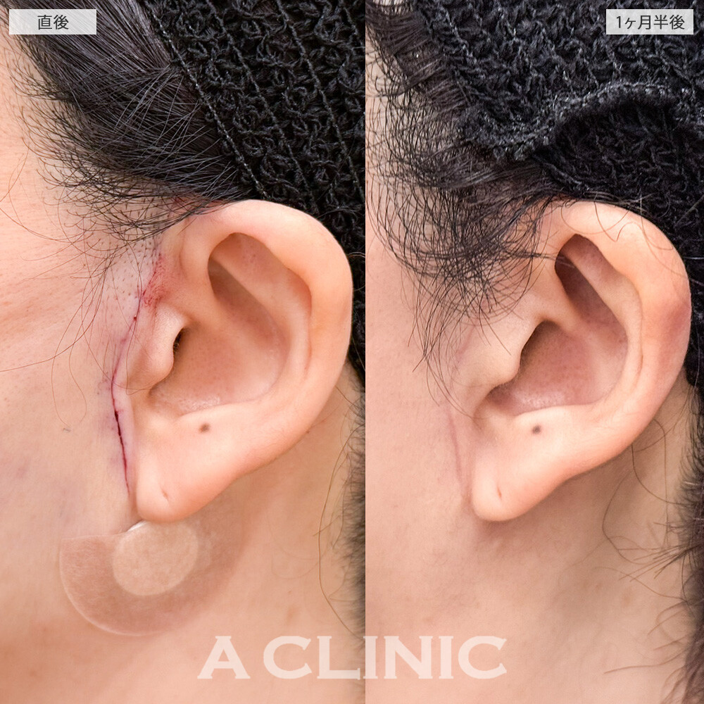 A式美肌たるみ切開と1day小顔脂肪吸引で、たるみとしわを同時に撃退！こちら処置前と１ヶ月半後の症例です(30代女性)